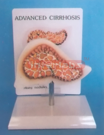 DESK-TYPE, ADVANCED CIRRHOSIS MODEL WITH DESCRIPTION PLATE